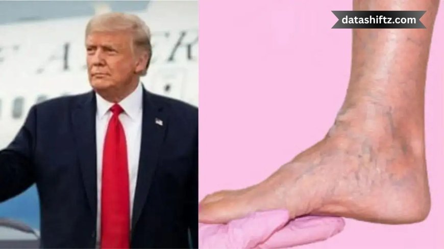 Trump’s Chronic Venous Insufficiency: What You Need to Know